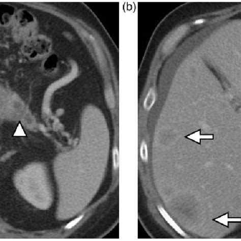 Pancreatic Neuroendocrine Tumor A Axial Ct Image Demonstrates A