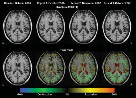 Posterior Cortical Atrophy The Lancet Neurology