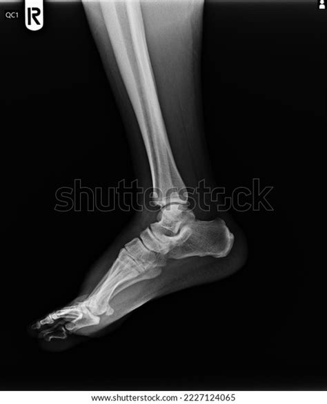 20,942 X Ray Fracture Bone Images, Stock Photos, 3D objects, & Vectors ...