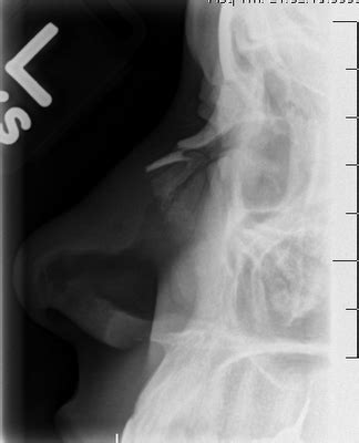 Facial Fractures, Facial Trauma, Facial Reconstruction: Facial Fractures. Nasal Bone Fractres