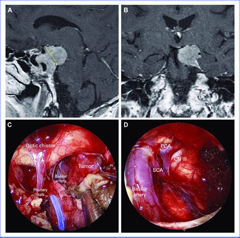 Illustrative Case Recurrent Gonadotroph Adenoma With Invasion