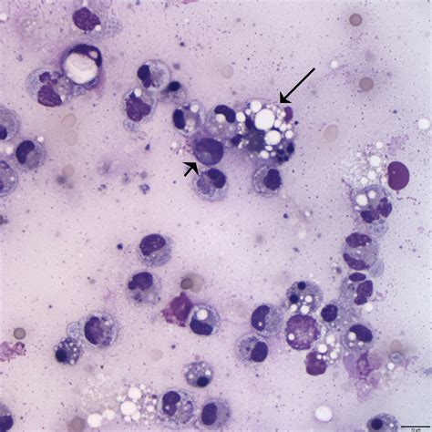 Figure 1b Peritoneal Fluid Eclinpath