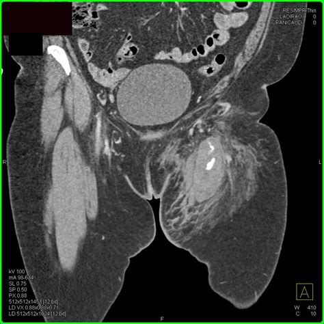 Induration Left Groin from Prior Catheterization - Vascular Radiology ...