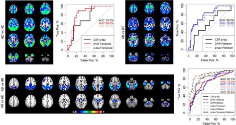 A New Biomarker Makes It Easier To Distinguish Between Alzheimers And