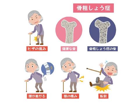 骨密度を上げる食べ物＆運動で骨粗鬆症・骨折予防！ ハルメク美と健康