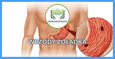 Wrzody O Dka I Dwunastnicy Zdrowopedia