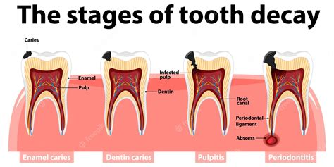 Tooth Decay Diagram