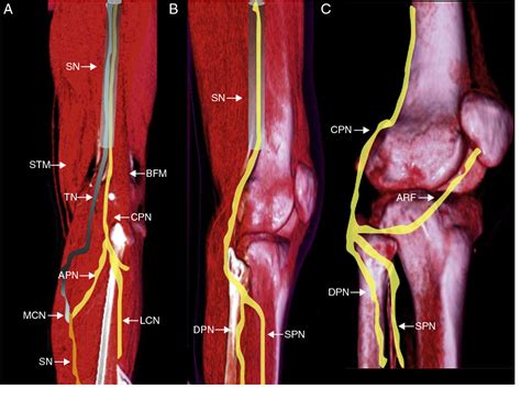 Figure 1 From [high Resolution 3t Magnetic Resonance Neurography Of The Peroneal Nerve