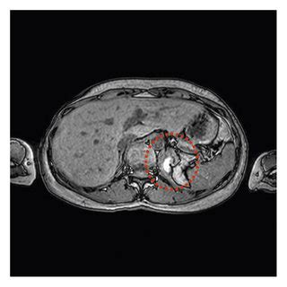 Computed Tomography Findings On Admission Contrast Enhanced Coronal