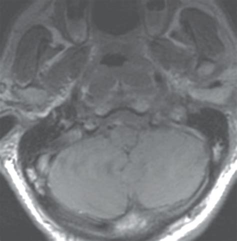 Mri Assessment Of The Jugular Foramen Sagittal A And Axial B Mri