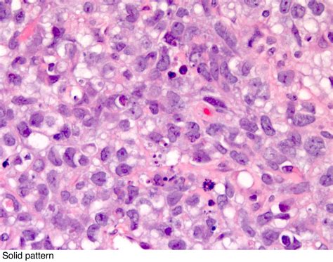 Pathology Outlines Yolk Sac Tumor