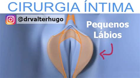 Cirurgia Intima Quanto Custa E Fotos Dr Valter Youtube