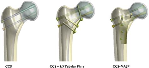 Medial Anatomical Buttress Plate In Treating Displaced Femoral Neck