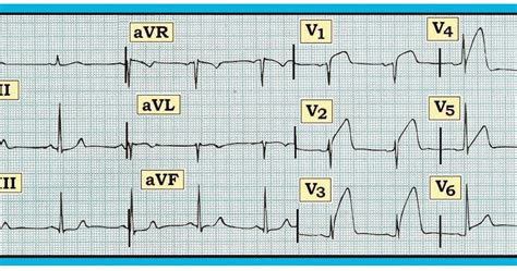 ECG Interpretation: ECG Interpretation Review #82 (Acute STEMI – RCA ...