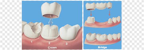 Bridge Crown Dentistry Tandheelkundige Restauratie Brug Brug