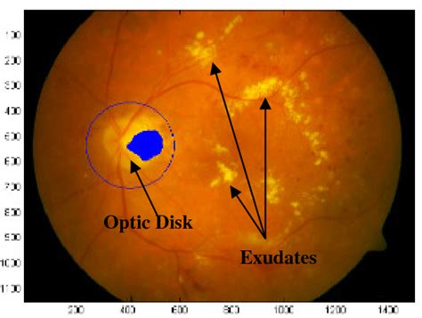 Figure 1 From Diabetic Retinopathy Screening Using Computer Vision Semantic Scholar