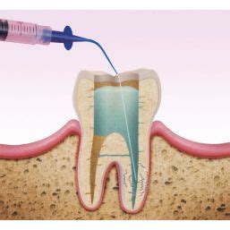 Buy Endodontics Supplies Online Orien Dental Supplies