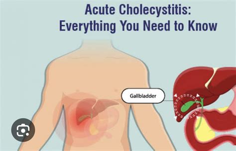 Acute Calculus Cholecystitis Dr Avinashtank Is A Super Specialist Mch Laparoscopic Gastro