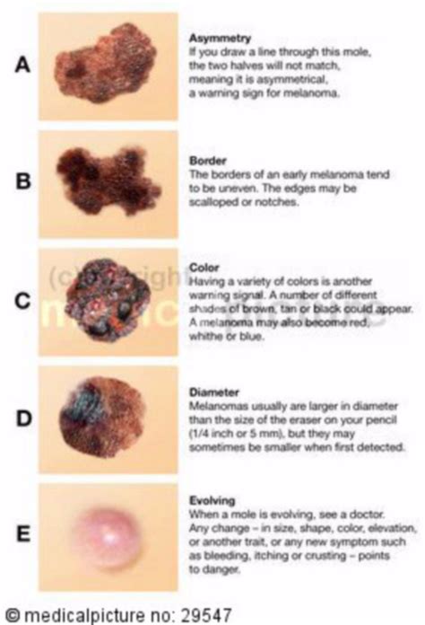 Abcde Rule For Skin Cancer What It Means And How To Use It Off