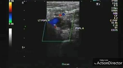 Ultrasound imaging: Popliteal-artery-thrombosis