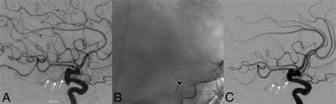 Baseline Lateral Dsa Projection A Demonstrating A Posterior