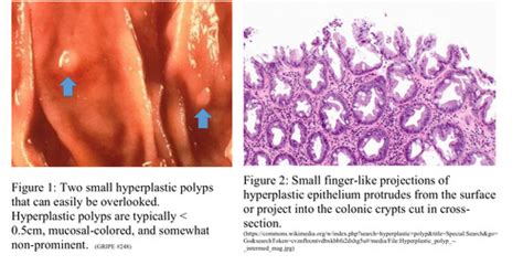 Neoplasia Of The Lower Gi Tract Flashcards Quizlet