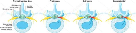 Ilustración Que Muestra Un Esquema De Hernia Discal Disco Normal