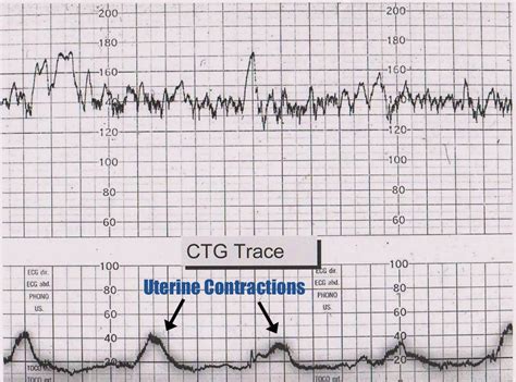 How To Read A Ctg Geeky Medics