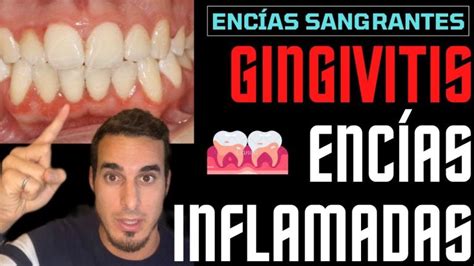 Cómo prevenir la gingivitis Actualizado julio 2023