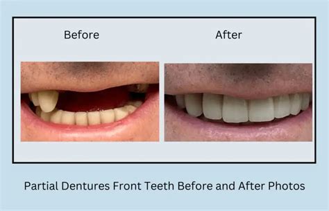 Partial Dentures Front Teeth Before and After Photos - Oral Health Line