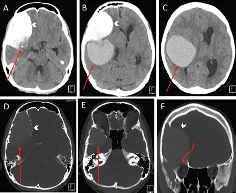 Simultaneous Discrete Intradiploic And Intracerebral Atypical Epidermoid Cysts Possible