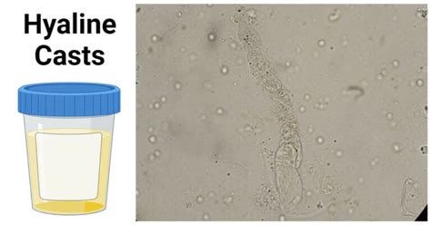 Hyaline Casts: Structure, Types, Process, Importance