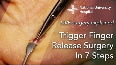 LIVE Surgery Explained Trigger Finger Release Surgery In 7 Steps YouTube