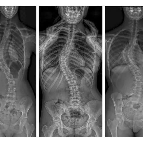 Different Curve Patterns Associated With Painful Adolescent Idiopathic