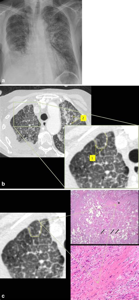 Lymphangitic Carcinomatosis A Chest Radiograph Showed A Pleural Download Scientific Diagram