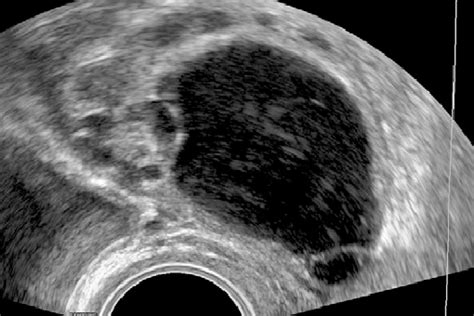 Transvaginal Scan Characteristic B Mode Ultrasound Findings Of Impure