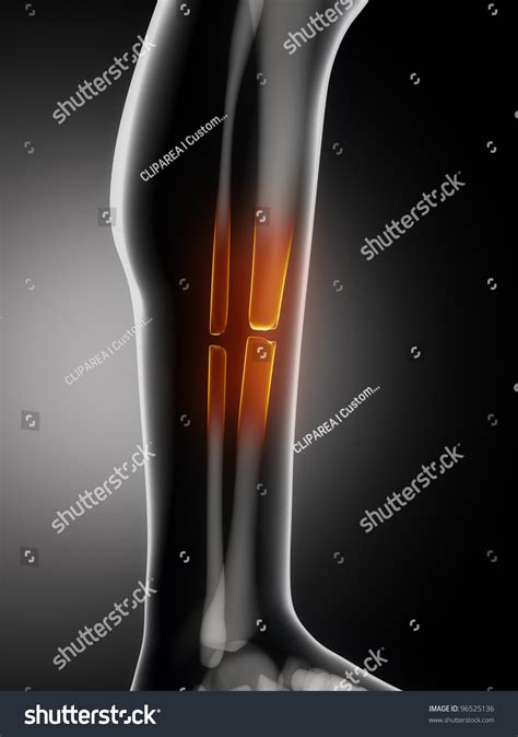 broken leg stock illustration  shutterstock