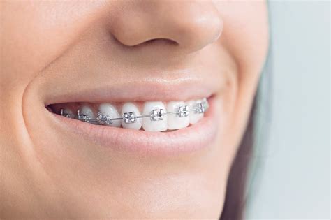 CARE DURING ORTHODONTIC TREATMENT Dentistry And Dental Implants Blog