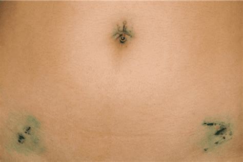 Stomach Pictures After Myomectomy Surgery