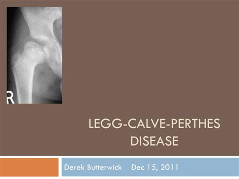 PPT - LegG -Calve- Perthes Disease PowerPoint Presentation, free ...