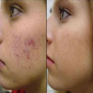 Natural Skin Treatments for Acne Scars