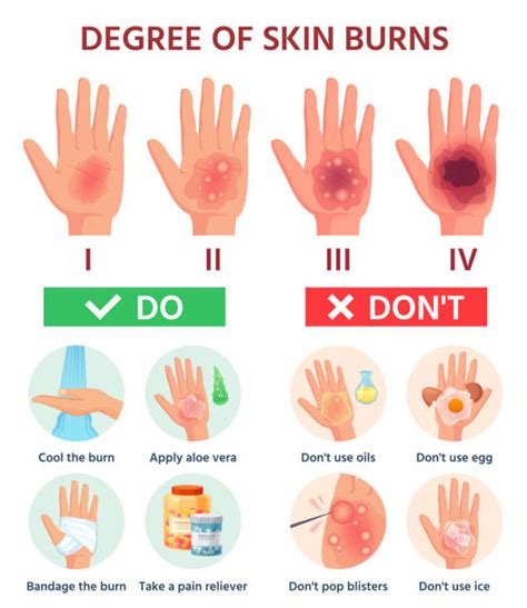 Difference Between 1st 2nd And 3rd Degree Burns