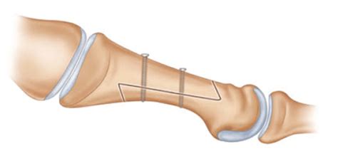 Schematic diagram of scarf osteotomy. | Download Scientific Diagram