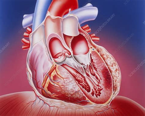 Heart After Heart Attack Stock Image M1720206 Science Photo Library