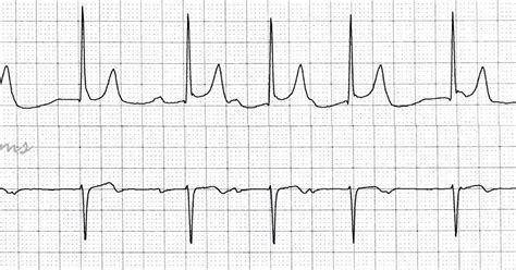 Ecg Rhythms Sr Second Degree Av Block Type I Junctional Escape Beats