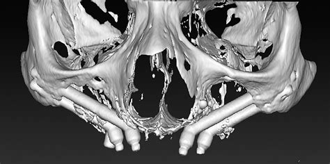 Quad Zygoma Protocol Atlas Of The Oral And Maxillofacial Surgery