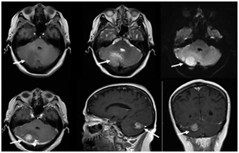 Medulloblastoma in an elderly patient: A case report and literature review