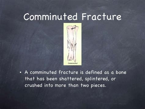 Comminuted, Simple, and Compound Fractures