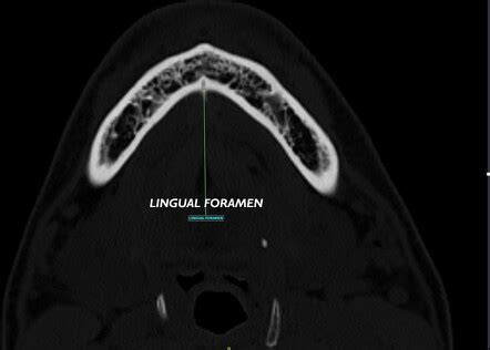 Lingual Foramen Radiology Reference Article Radiopaedia Org