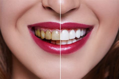 Veneers vs. Lumineers: Which Is Better for Your Smile?